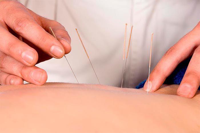 Acupunctuurnaalden