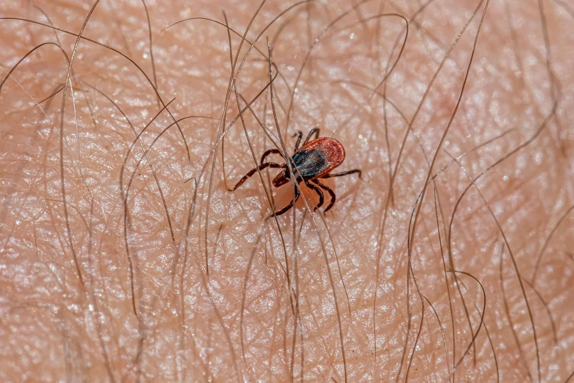 Tick embedded in human skin, appearing red and black with visible legs.