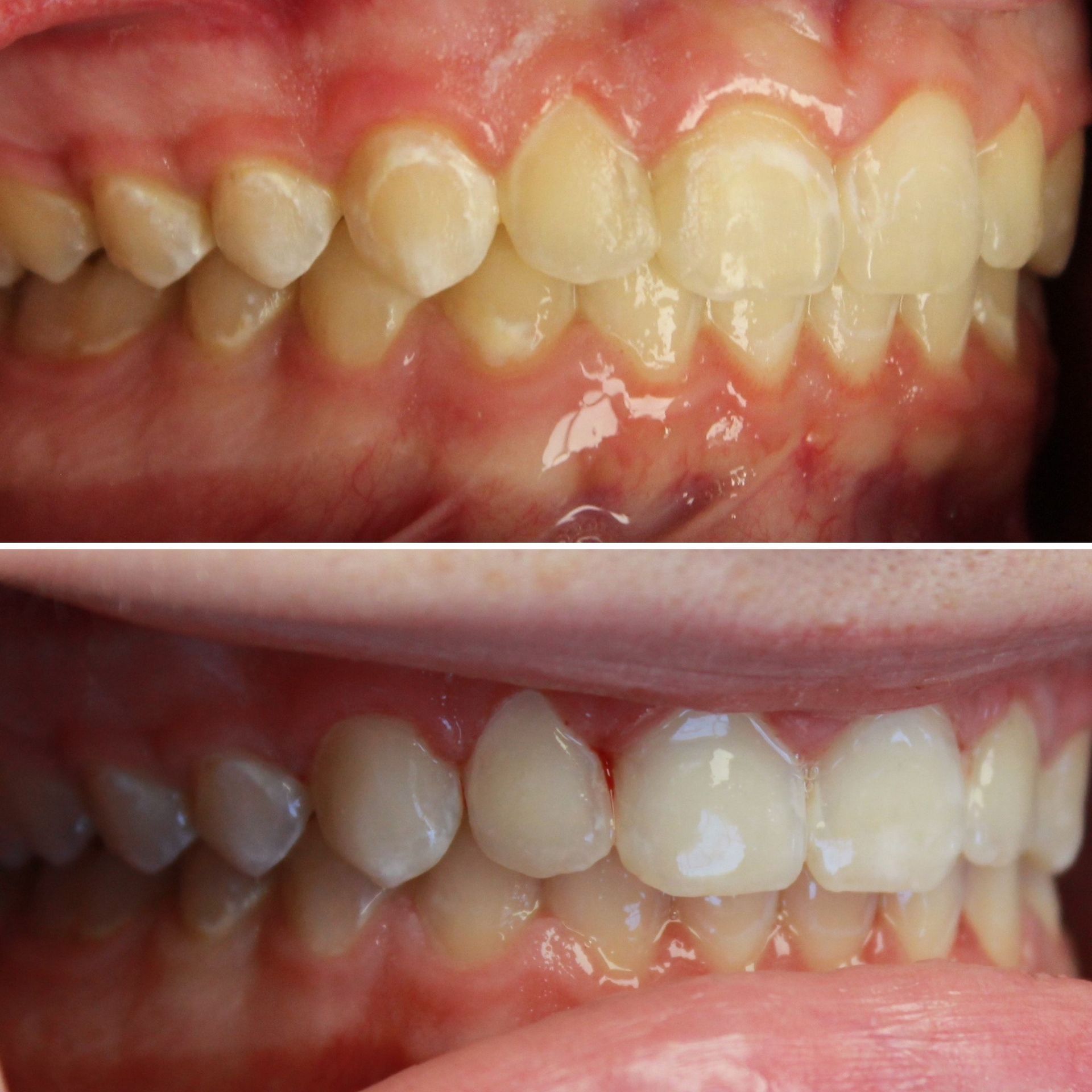 A before and after picture of a person 's teeth.