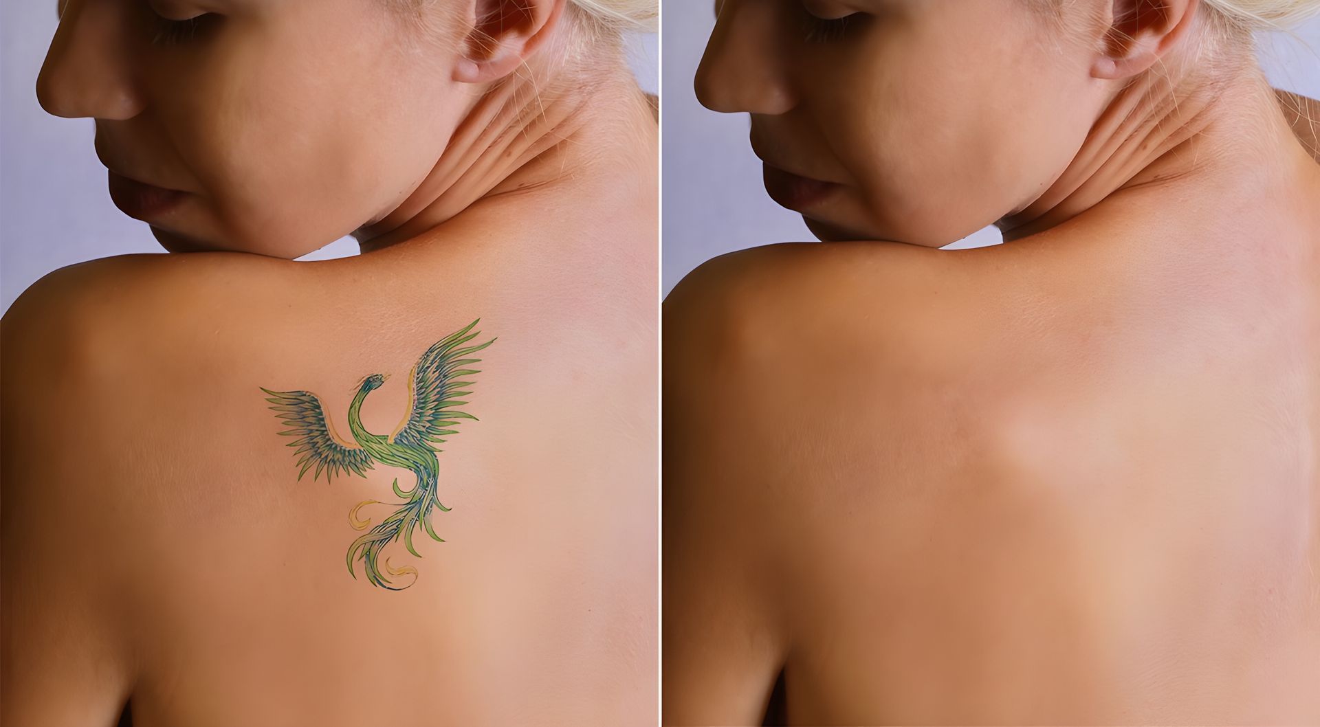 Woman's Back With A Green Tattoo Of A Phoenix On The Left, Tattoo Removed On The Right — Tattoo Inc Studio in Robina, QLD