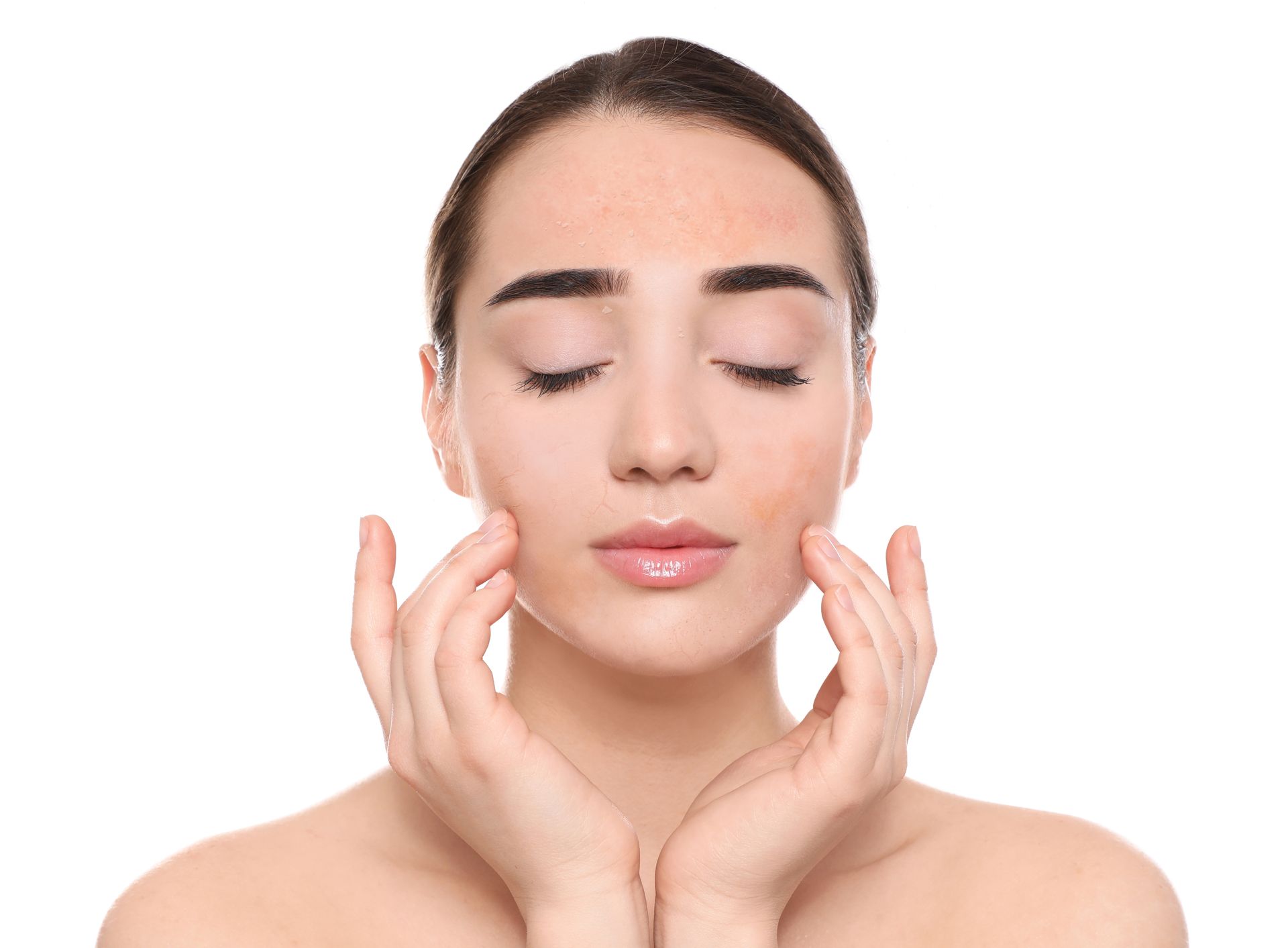 Dehydrated skin of the women
