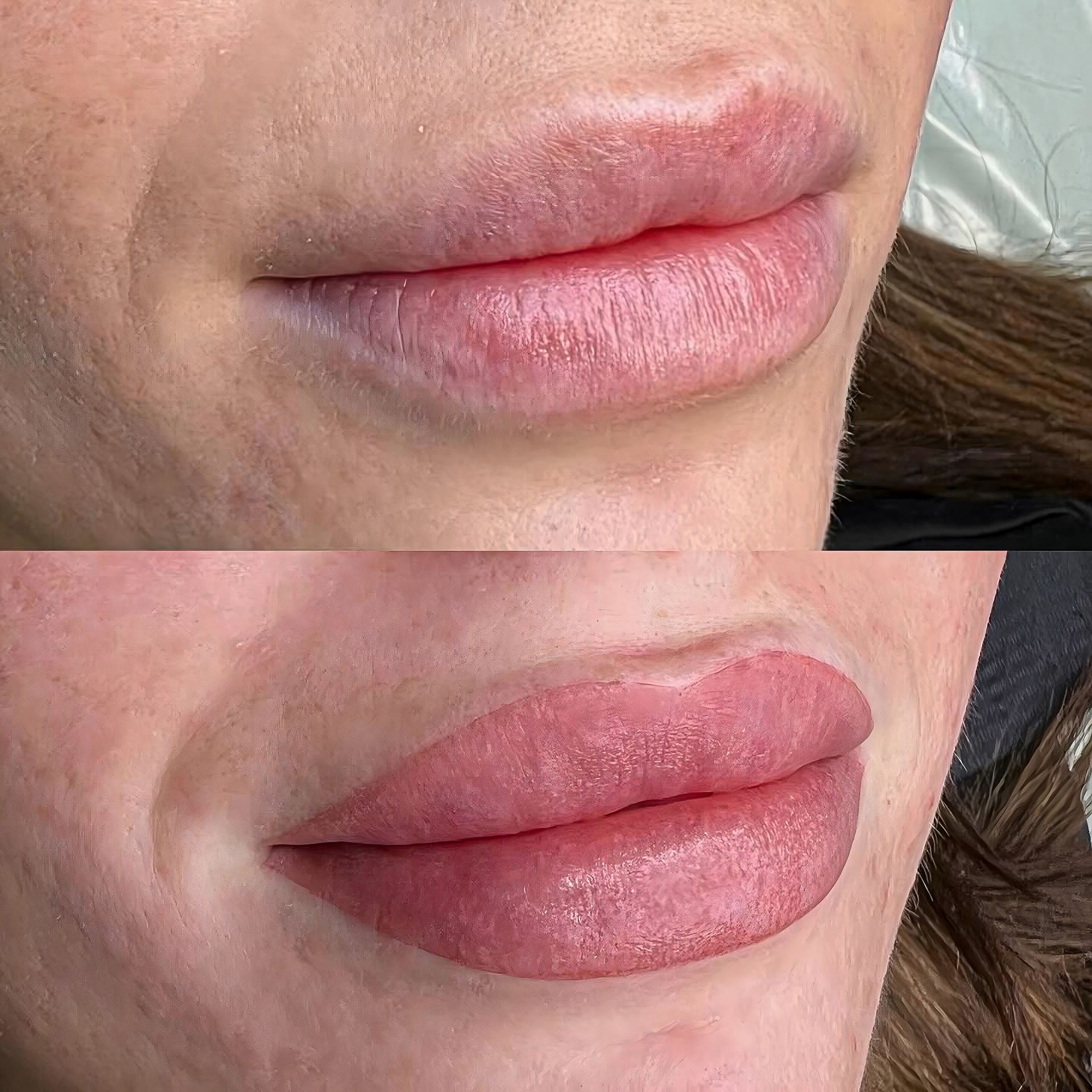 Comparison of lips before and after cosmetic lip enhancement; bottom lip is fuller and pink.