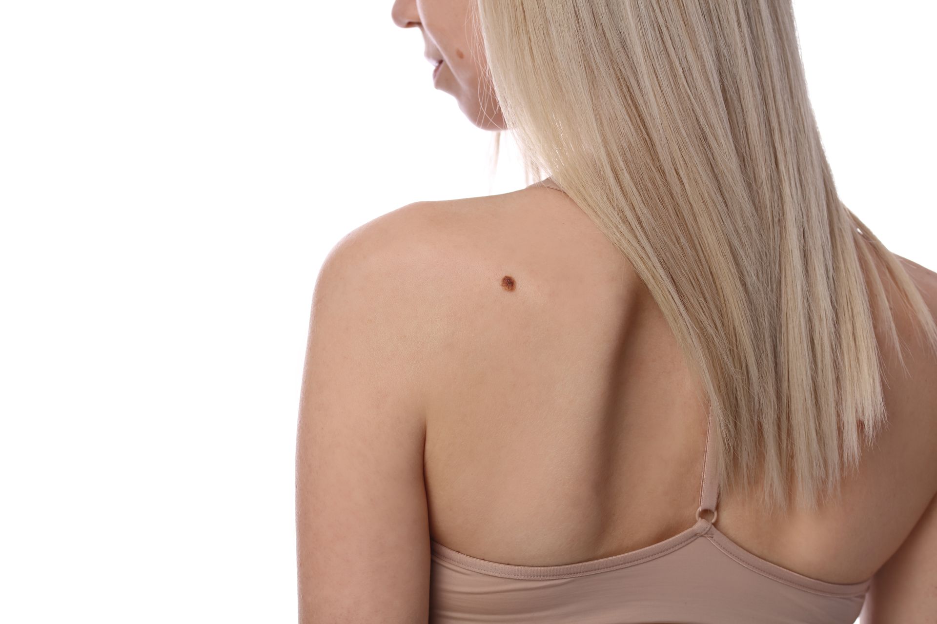 A woman in a bra has a mole on her back.