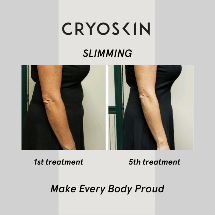 Body Sculpting Gallery Chesterfield, MO The Finer Points Spa & Body