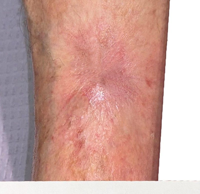 Healed Wound