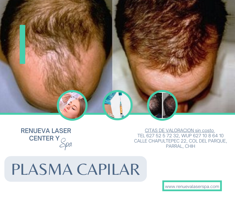 PLASMA CAPILAR