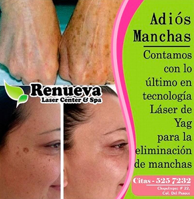 RENUEVA LÁSER CENTER & SPA - Eliminación de manchas