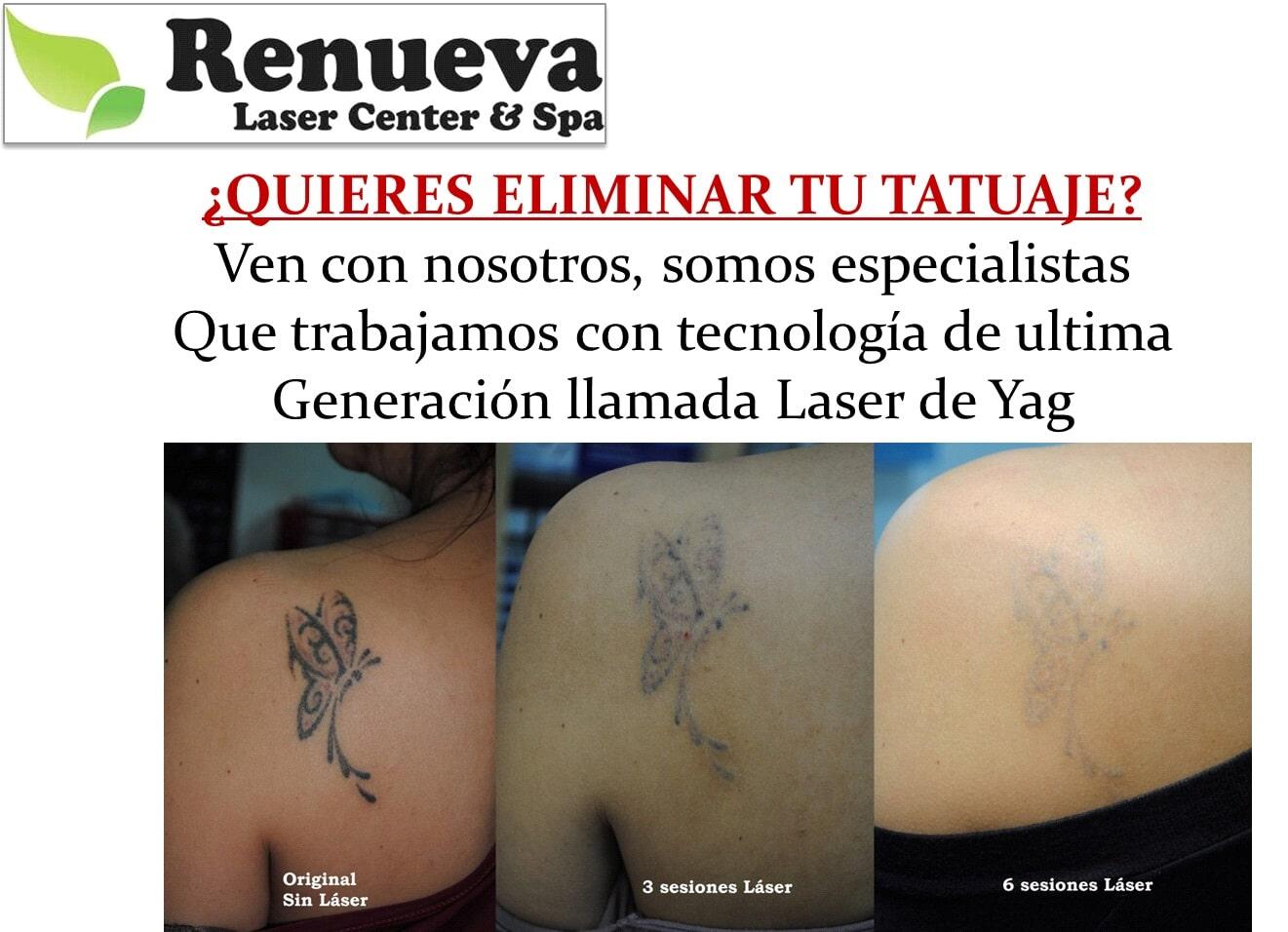 RENUEVA LÁSER CENTER & SPA - Eliminación de tatuajes