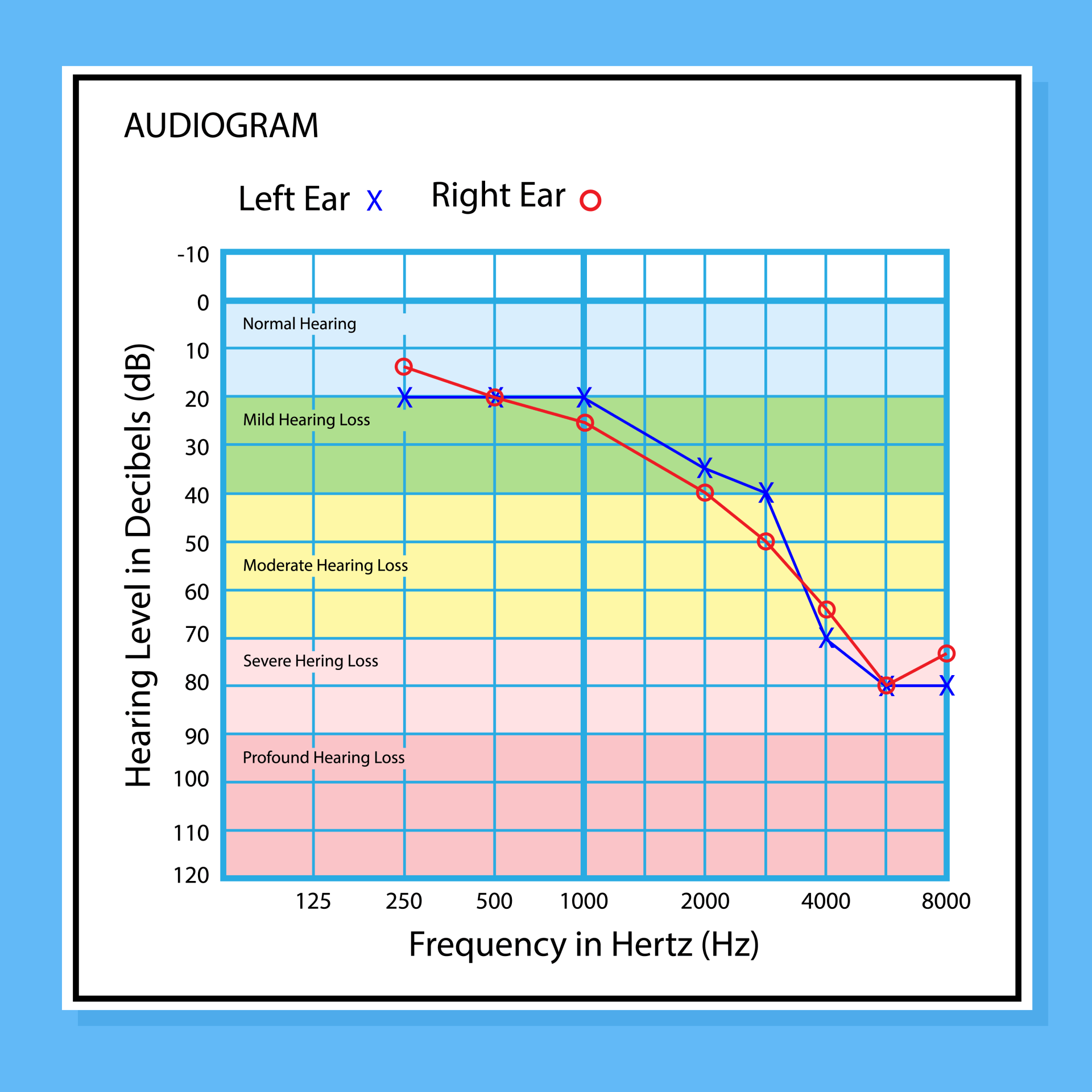 Audiogram graph. Blue and red lines show hearing levels for left and right ears across frequencies.