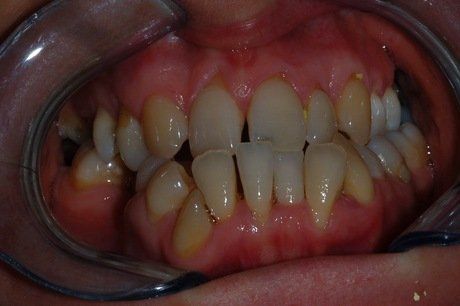 Primo piano di denti inseriti in un divaricatore dentale, che mostra l'affollamento dentale sia nell'arcata superiore che in quella inferiore.