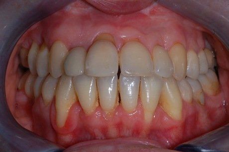 Primo piano di denti e gengive con evidente disallineamento e affollamento dei denti frontali.