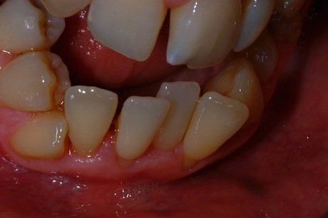 Primo piano di una bocca con denti inferiori storti e gengive visibili.