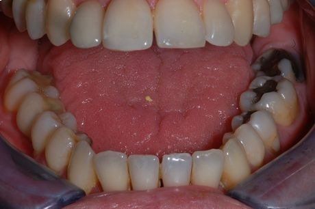 Bocca aperta che mostra denti con carie scure e macchie gialle sui molari inferiori