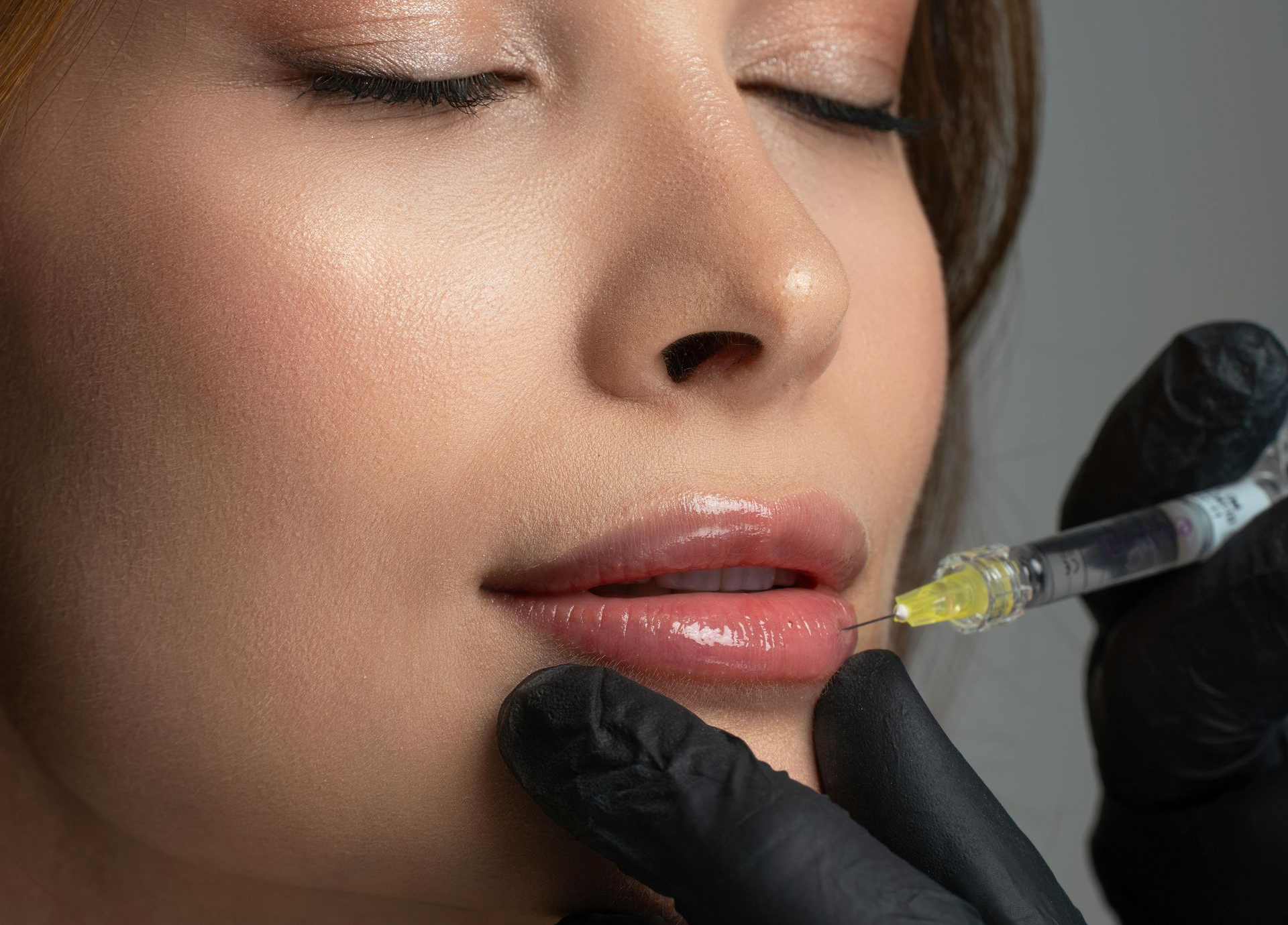 lip augmentation injection into lower lip of client