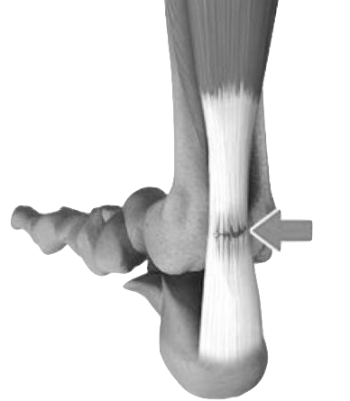 Achilles Tendon