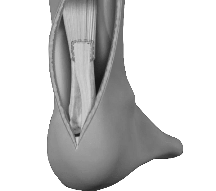 Achilles Tendon Repair