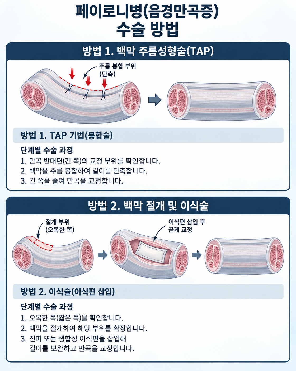 음경만곡증 교정 수술 모식도 — 부산 서면 유로진남성의원