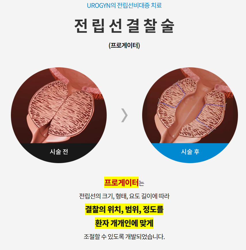 프로게이터 봉합사 결찰 단계 모식도 — 부산 서면 유로진남성의원