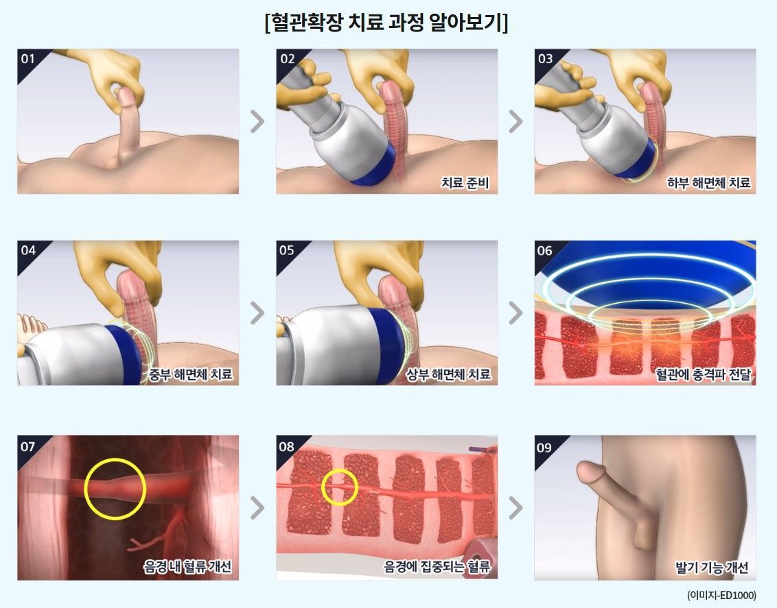 저강도 충격파 치료 과정 — 부산 서면 유로진남성의원