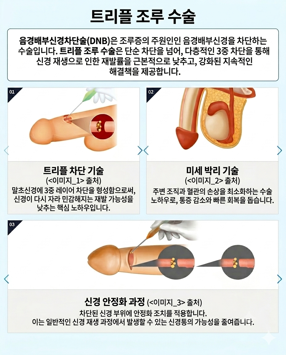 조루 신경차단술 수술 모식도 — 부산 서면 유로진남성의원