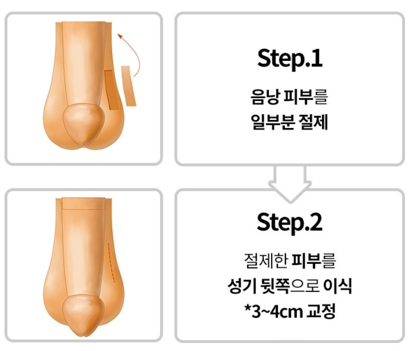 음낭피판술 수술 모식도 — 부산 서면 유로진남성의원
