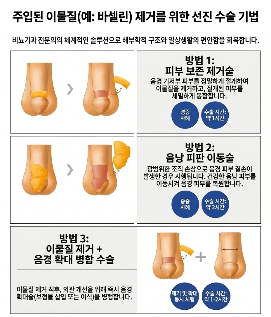 바세린 이물 제거 수술 모식도 — 부산 서면 유로진남성의원