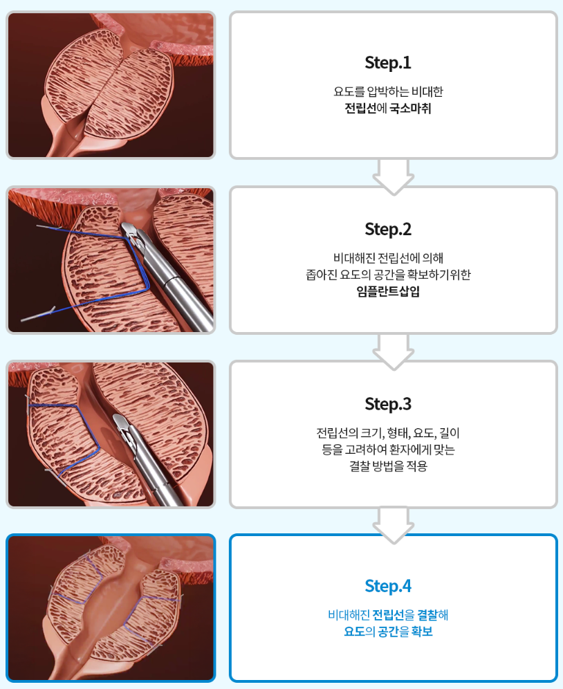 프로게이터 전후 모식도 — 요도 개방
