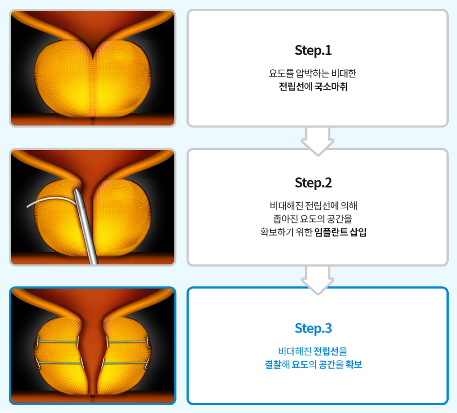 유로리프트 전후 모식도 — 소변 흐름 개선