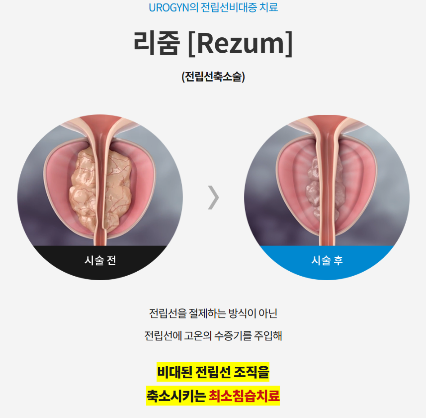 리줌 수증기 주입 모식도 — 부산 서면 유로진남성의원