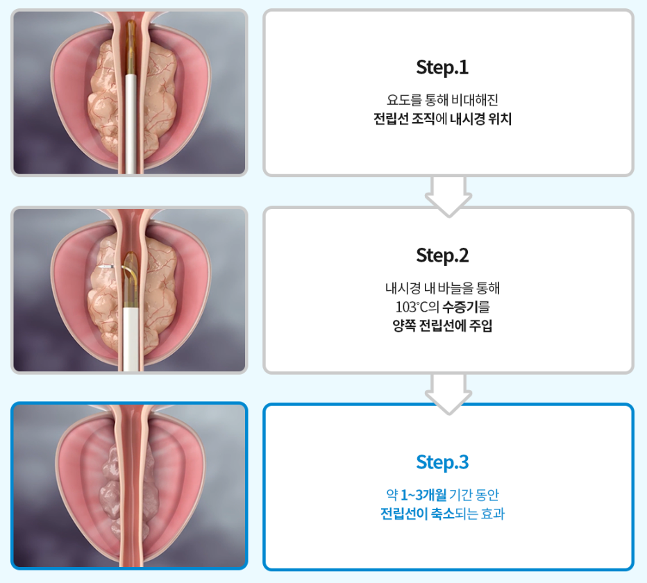 리줌 전후 모식도 — 전립선 부피 감소