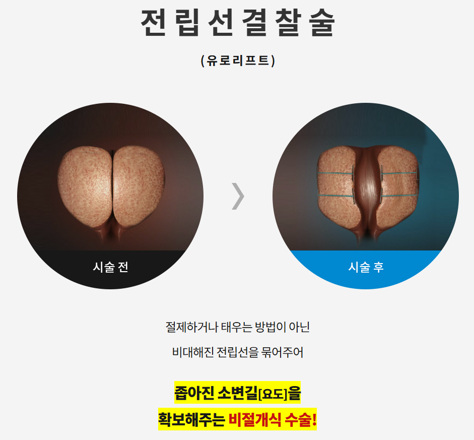 유로리프트 임플란트 원리 — 부산 서면 유로진남성의원