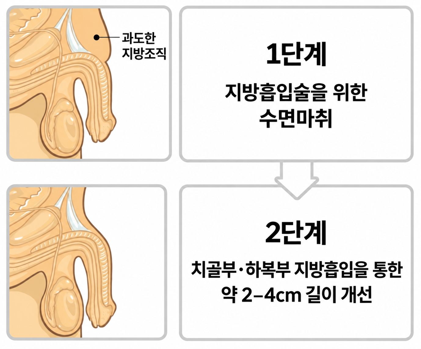 함몰음경 교정 수술 모식도 — 부산 서면 유로진남성의원