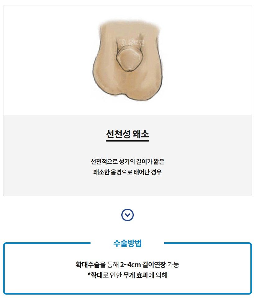 선천성 왜소음경 진료 과정 — 부산 서면 유로진남성의원