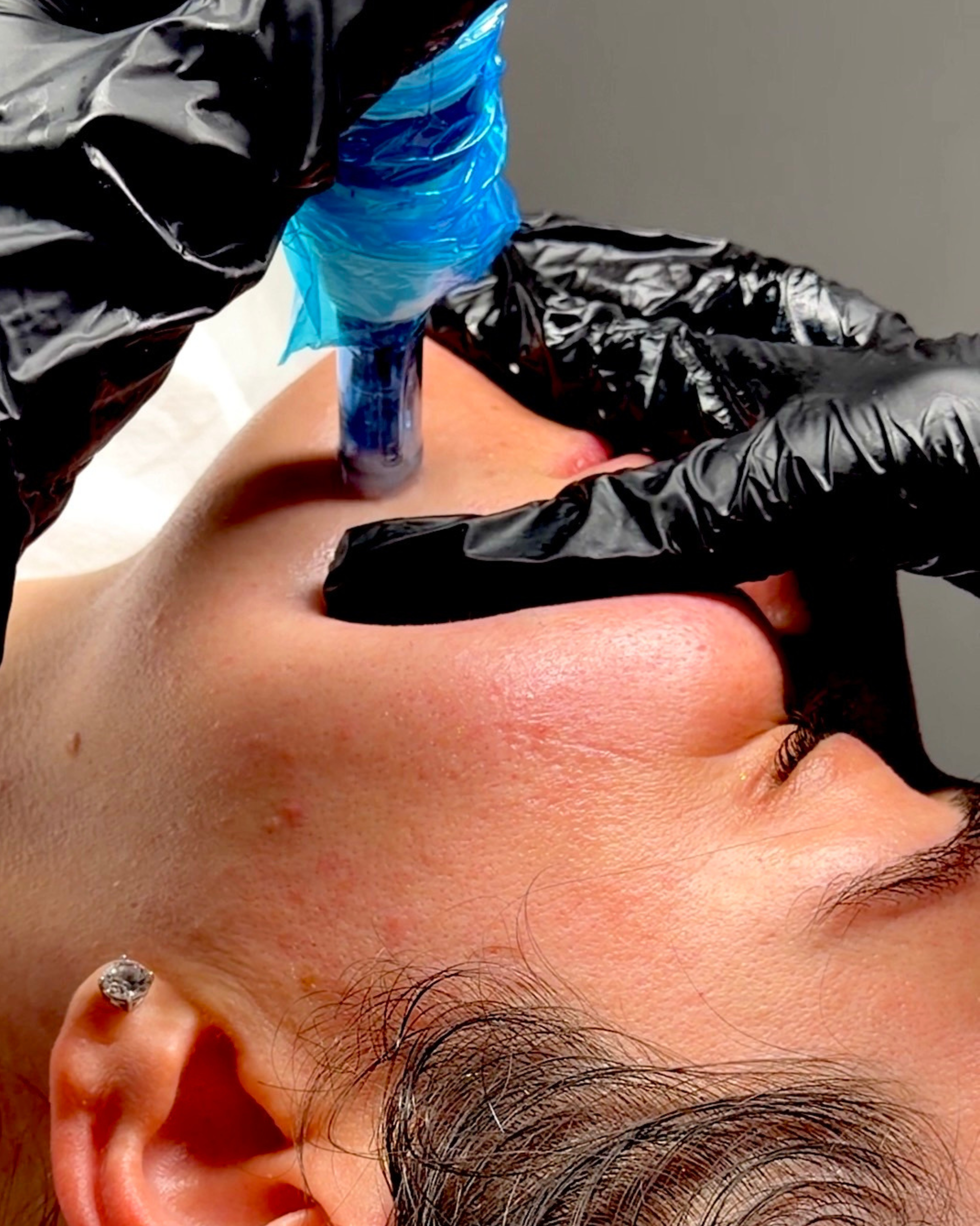 Therapist performing microneedling on a client’s face