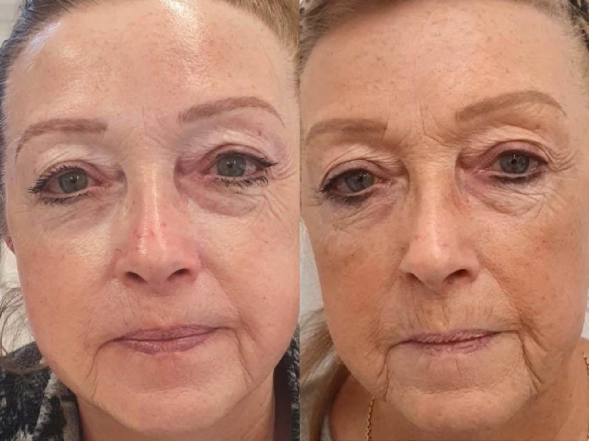 Before & After five Million Dollar Facial sessions and a home skincare routine, the client’s skin looks fimer and brighter.