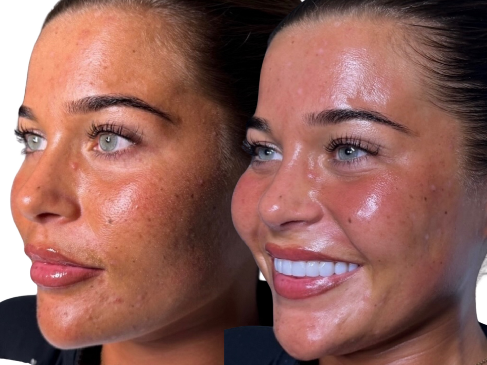 Before-and-after photos of a young client who has regular Million Dollar Facials. The after photo was taken following her third session and regular at-home skincare.