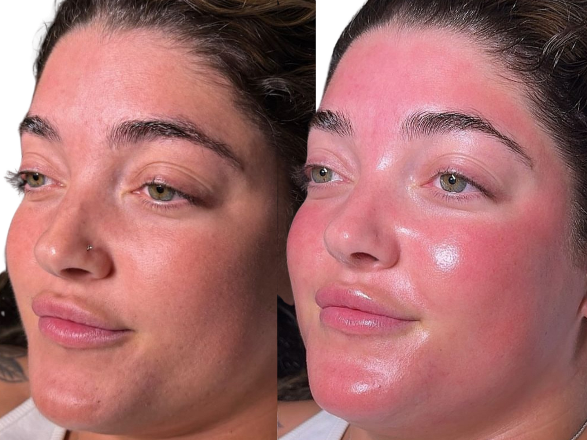 Before-and-after photos of a client who has regular Million Dollar Facials. The after photo was taken following her second session and regular at-home skincare.