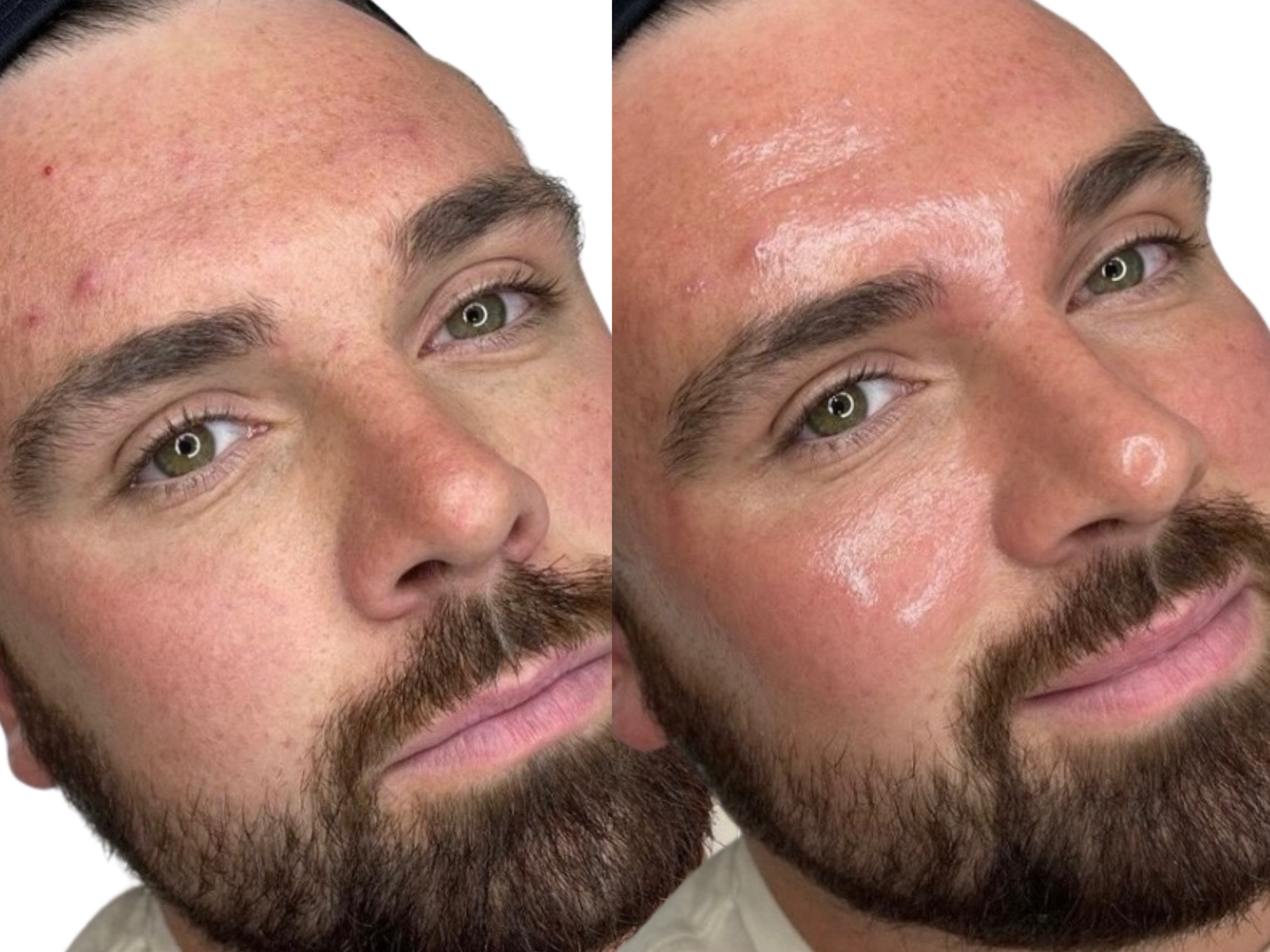 Before-and-after photos of a male client. The after photo was taken immediately after his second Million Dollar Facial.