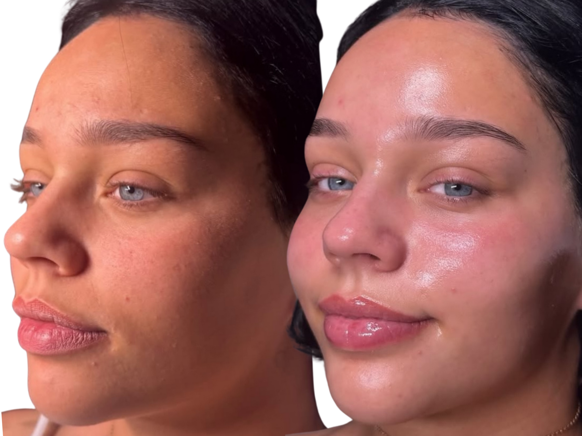 Before-and-after photos of a client following a Million Dollar Facial