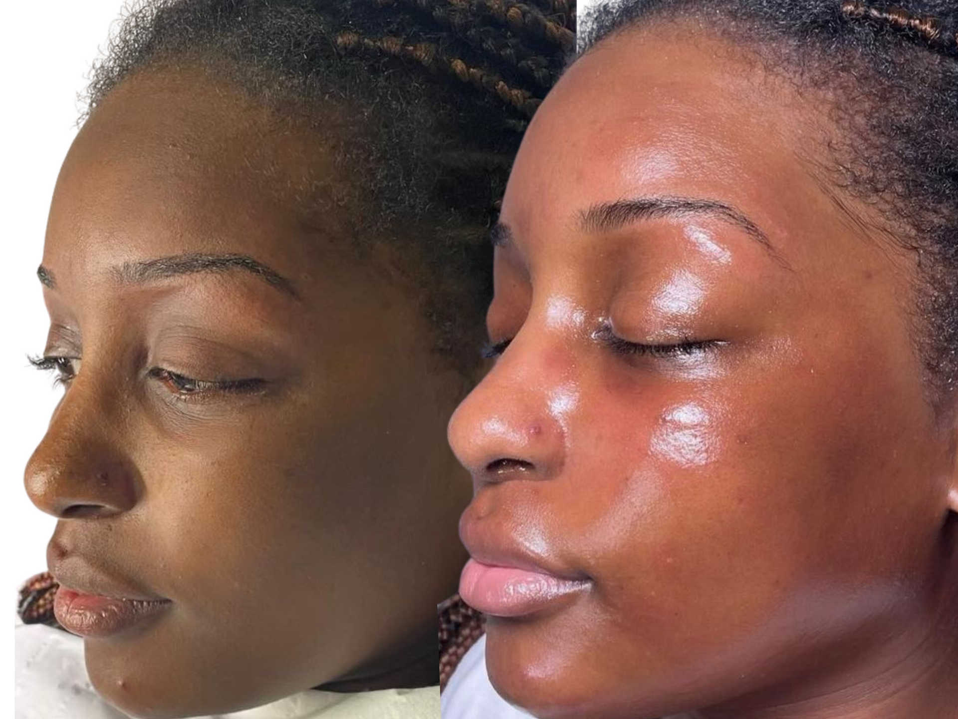 Before-and-after photos of a client. The after photo was taken immediately following a Million Dollar Facial.