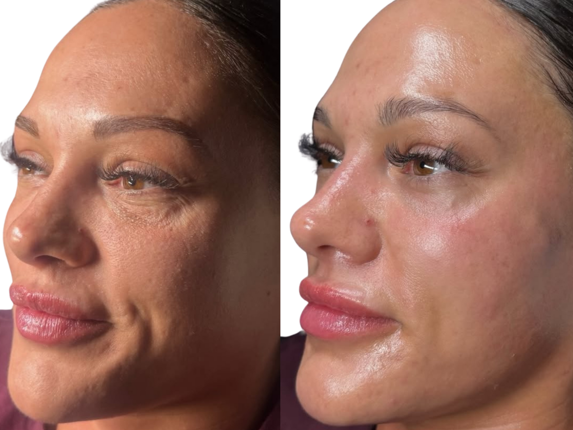 Before-and-after photos of a client, with the after photo taken following her second Million Dollar Facial. Her skin looks radiant and glowing.