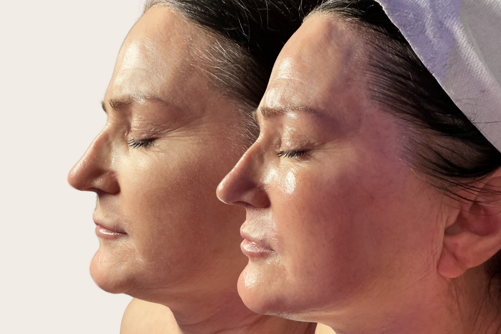 Before-and-after photos of a client, following her second Million Dollar Facial. 
