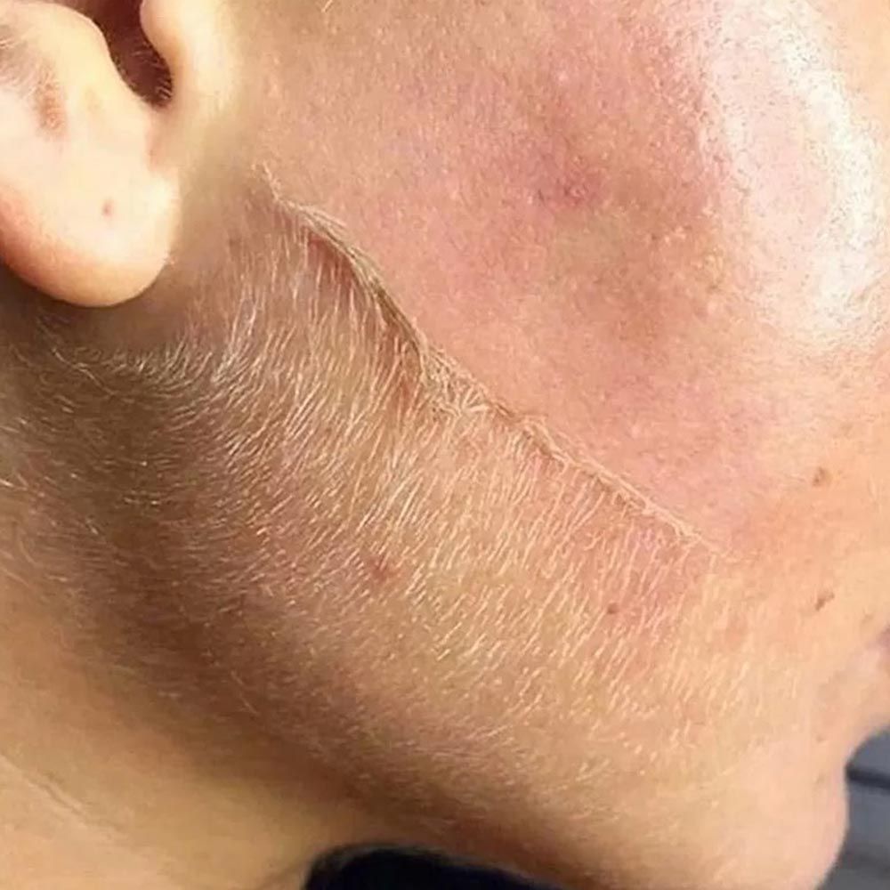 Close-up of a man’s cheek showing skin before and after dermaplaning.