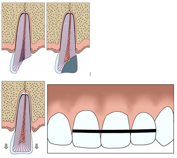 A diagram of a tooth with a brace on it