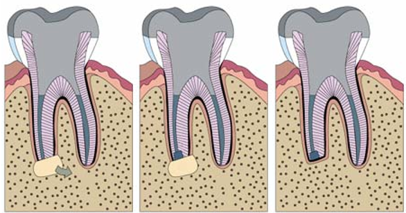 A diagram of a tooth being removed from the gums.