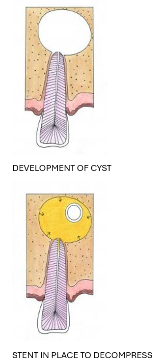 A diagram showing the development of a cyst and a stent in place to decompress it.