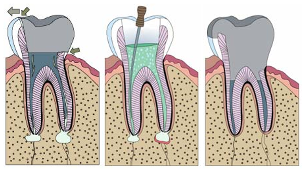 A diagram showing the process of a tooth being extracted