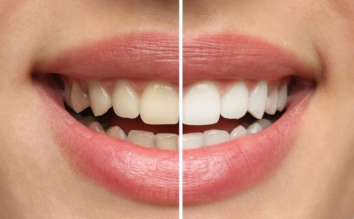 sbiancamento e igiene dentale a Bologna