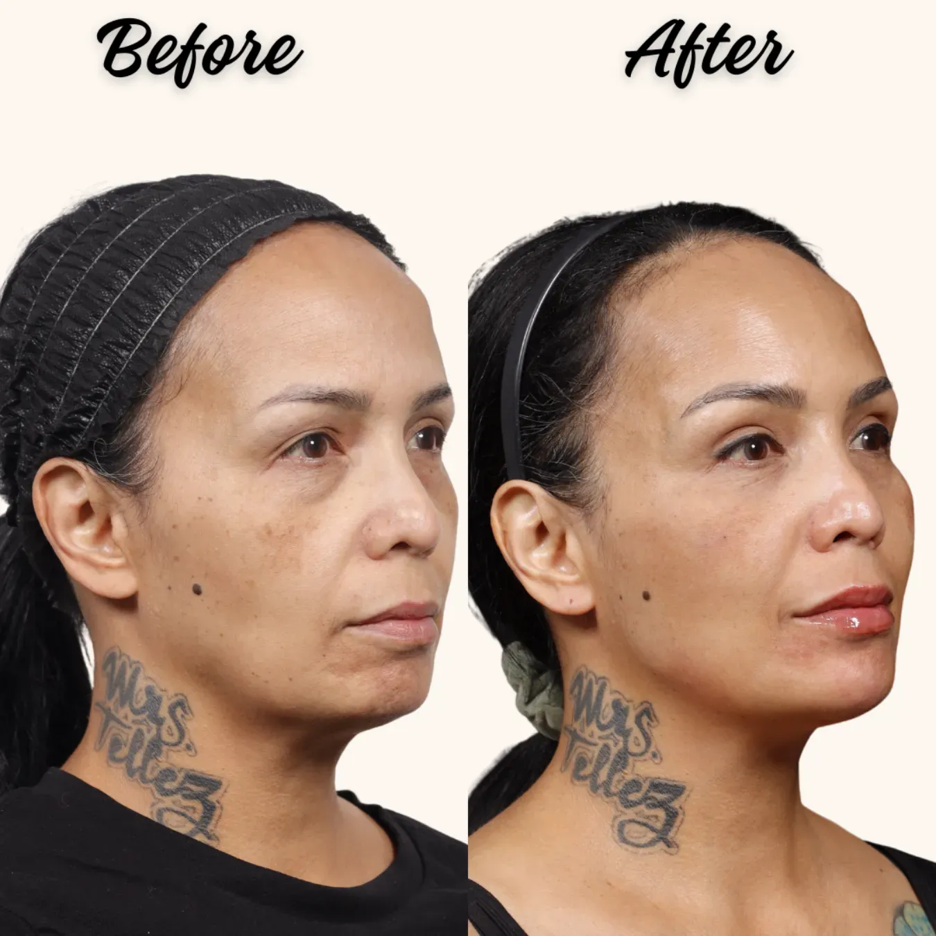 Before-and-after side profile of a woman with a smoother complexion and fuller lips on the right.