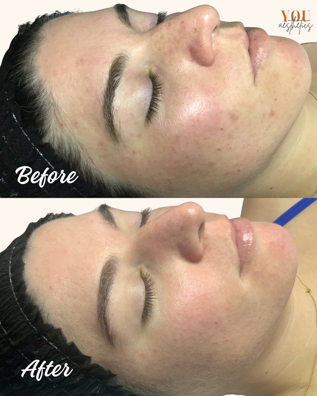 Before-and-after side-profile face photos showing reduced facial redness and acne.